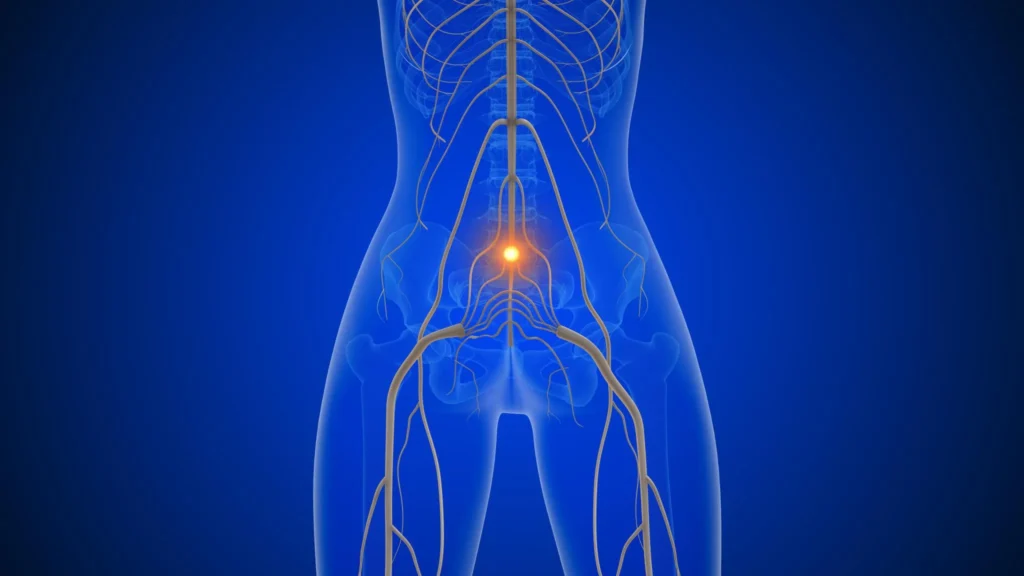 What Is Sciatica